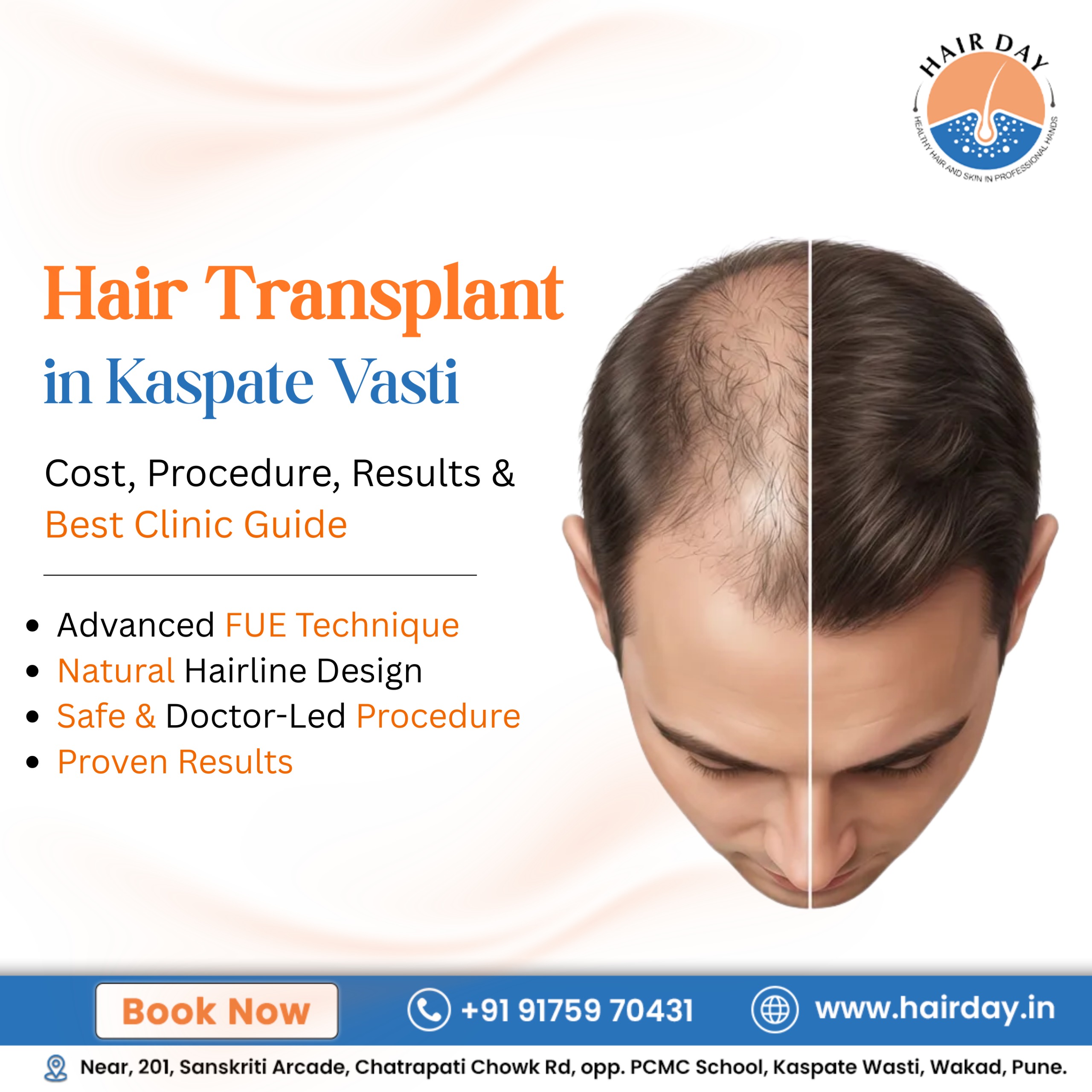 Hair Transplant in Kaspate Wasti